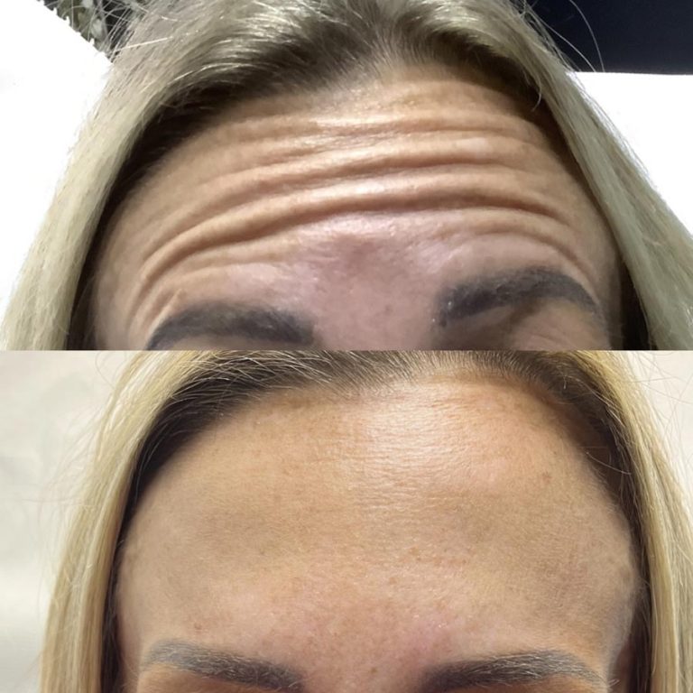 Anti wrinkle example