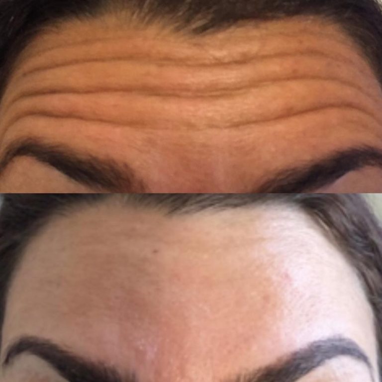 Anti wrinkle example