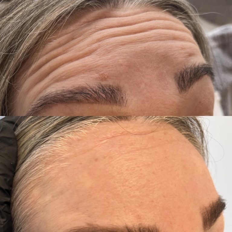 Anti wrinkle example