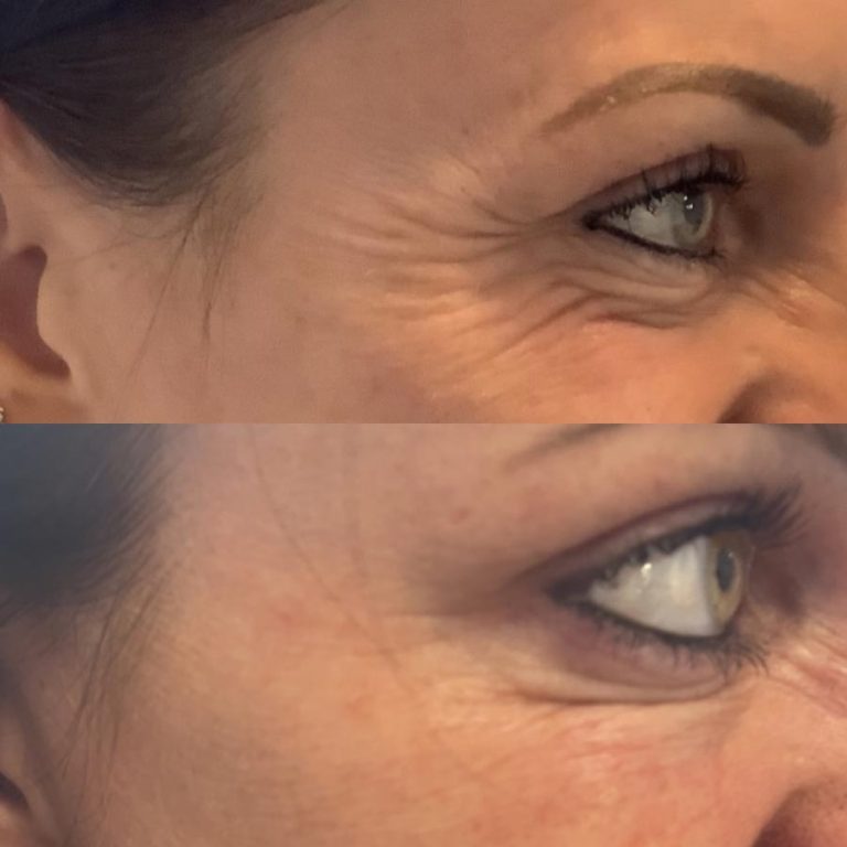 Anti wrinkle example