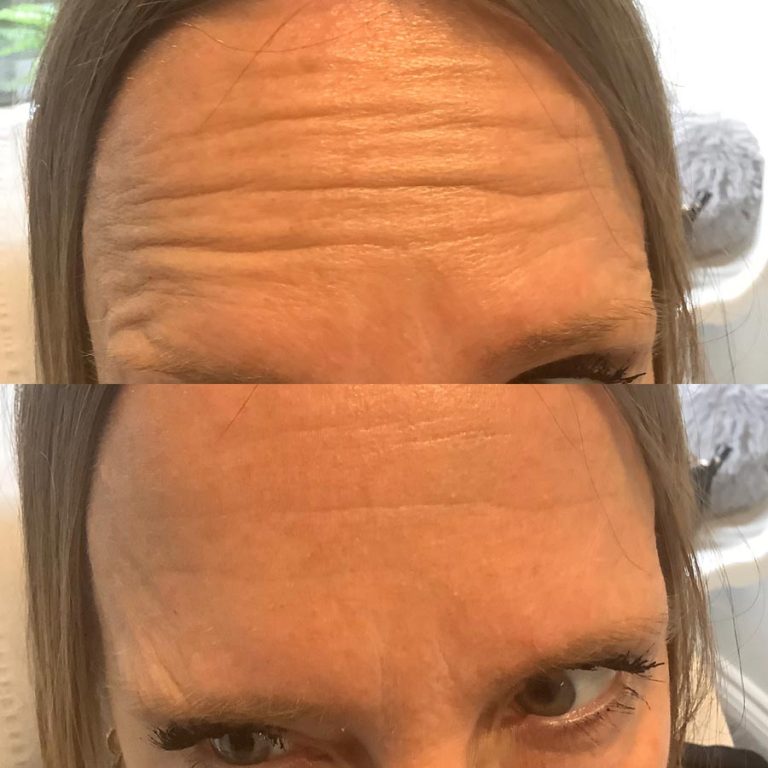 Anti wrinkle example