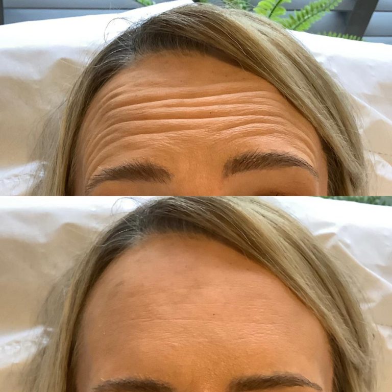 Anti wrinkle example