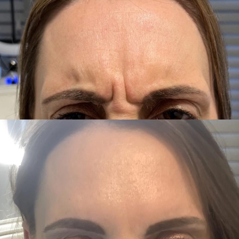 Anti wrinkle example