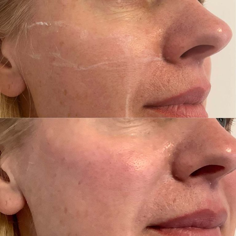 Cheek filler: Before and after