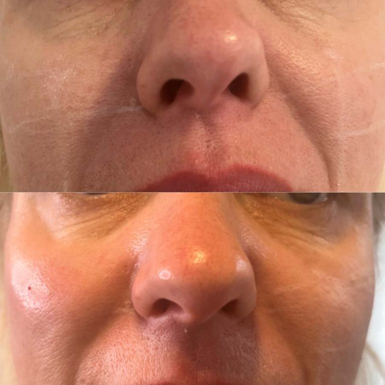 Cheek filler: Before and after