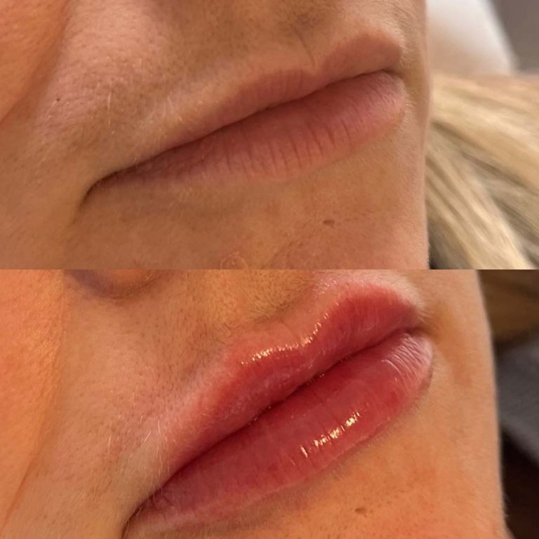 Lip filler: Before and after