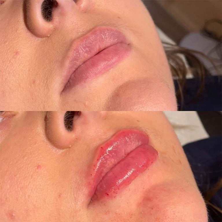 Lip filler: Before and after