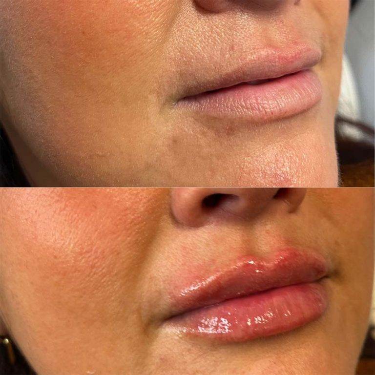 Lip filler: Before and after