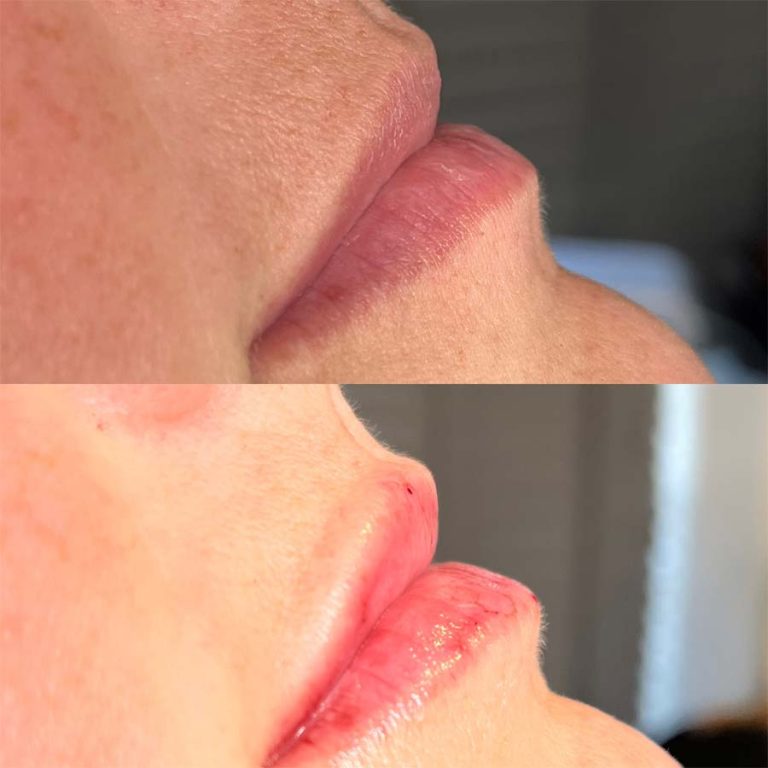 Lip filler: Before and after