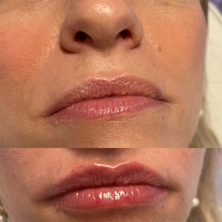 Lip filler: Before and after