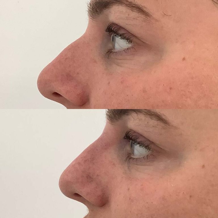 Nose filler: Before and after