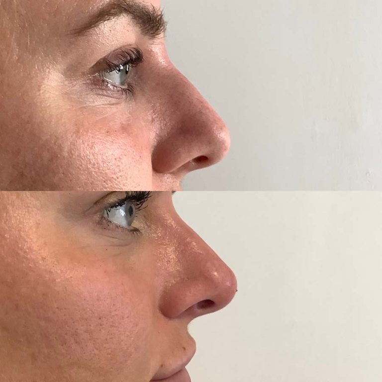 Nose tip lift